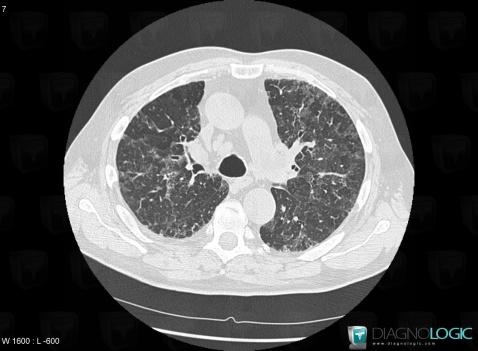 Desquamative interstitial pneumonitis, Pulmonary parenchyma, CT