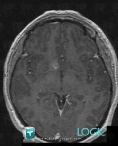 Developmental venous anomaly, Basal ganglia and capsule, MRI