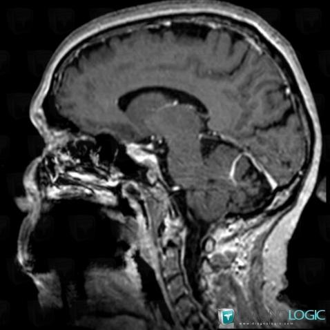 Developmental venous anomaly, Cerebellar hemisphere, Cerebral veins, MRI