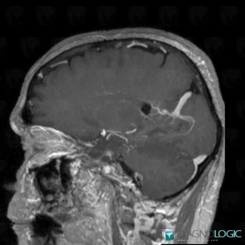 Developmental venous anomaly, Cerebral hemispheres, Cerebral veins, MRI