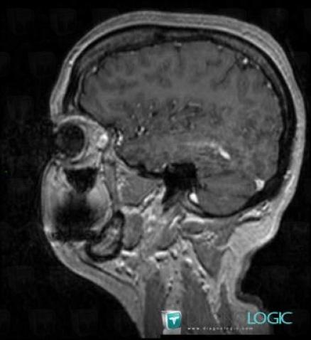 Developmental venous anomaly, Cerebral hemispheres, Cerebral veins, MRI
