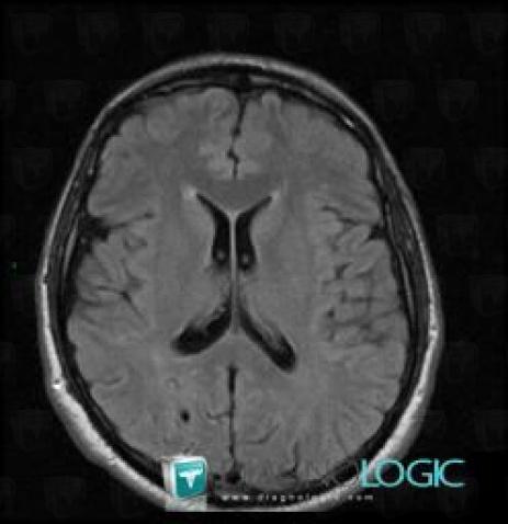 Developmental venous anomaly, Cerebral hemispheres, MRI