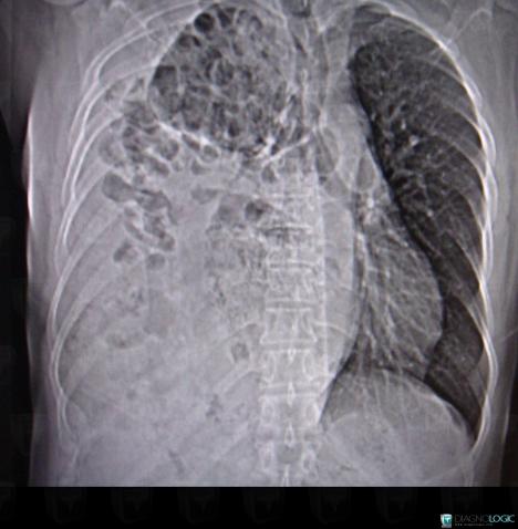 Diaphragmatic hernia, Diaphragm, CT