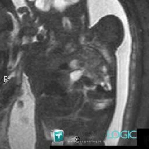 Diaphragmatic hernia, Diaphragm, MRI