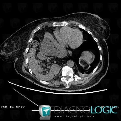 Diaphragmatic hernia, Mediastinum, CT