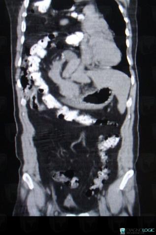 Diaphragmatic hernia, Mediastinum, CT