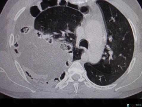 Diaphragmatic hernia, Pulmonary parenchyma, CT