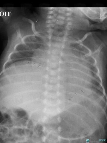 Diaphragmatic paralysis, Diaphragm, X rays