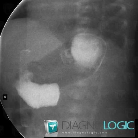 Diaphragme duodénal, Duodénum, Radio