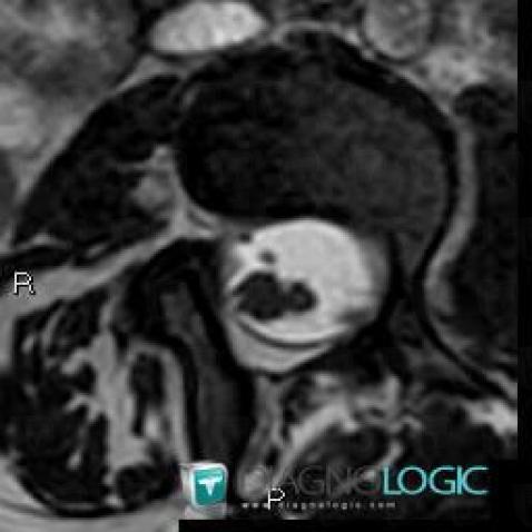 Diastematomyelia, Spinal canal / Cord, MRI