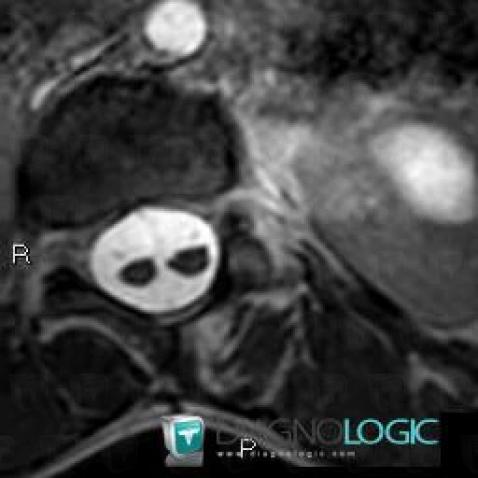 Diastematomyelia, Spinal canal / Cord, MRI