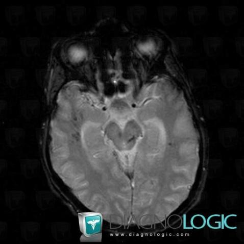 Diffuse axonal injury, Brainstem, Posterior fossa, MRI