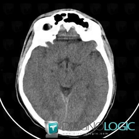 Diffuse axonal injury, Cerebral hemispheres, CT