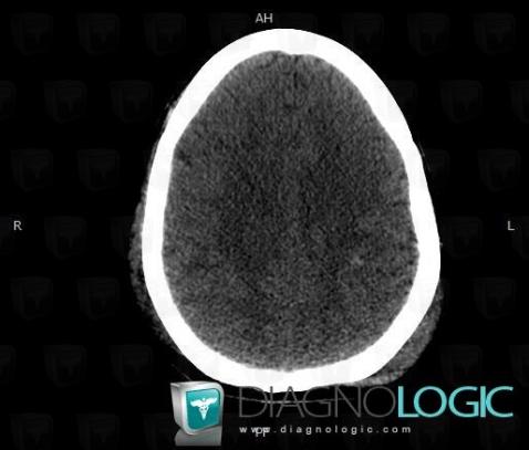 Diffuse axonal injury, Cerebral hemispheres, CT