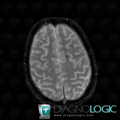 Diffuse axonal injury, Cerebral hemispheres, MRI