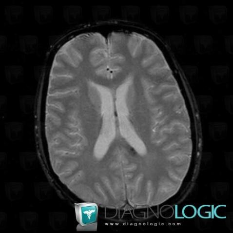 Diffuse axonal injury, Corpus callosum, MRI