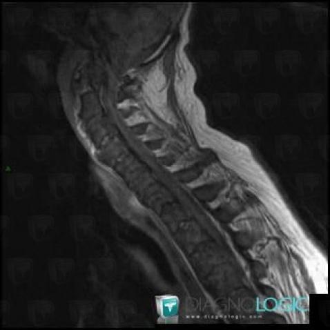 Diffuse idiopathic skeletal hyperostosis, Vertebral body / Disk, MRI