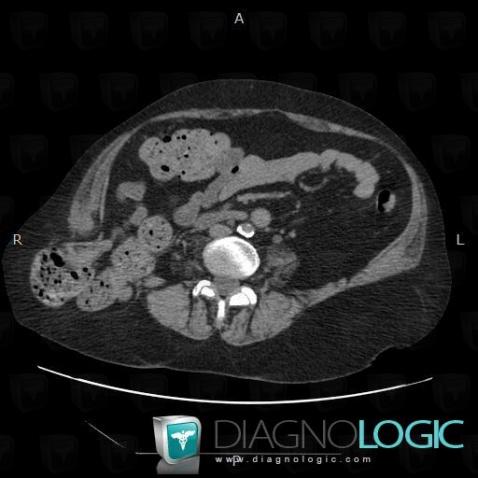 Diffuse lumbar hernia, Small bowel, Abdominal wall, CT