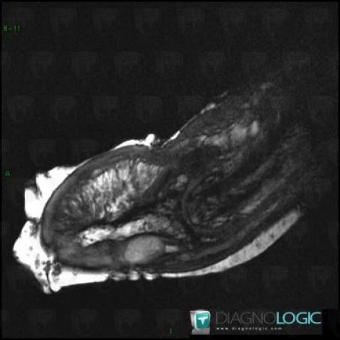 Digital mucous cyst, Phalanx / Sesamoid bones - Hand, MRI