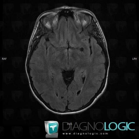Dilatation-the Virchow Robin space, Cerebral hemispheres, MRI