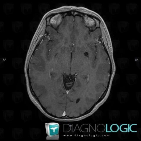 Dilatation-the Virchow Robin space, Cerebral hemispheres, MRI
