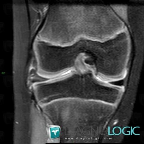 Discoid meniscus , Meniscus, MRI