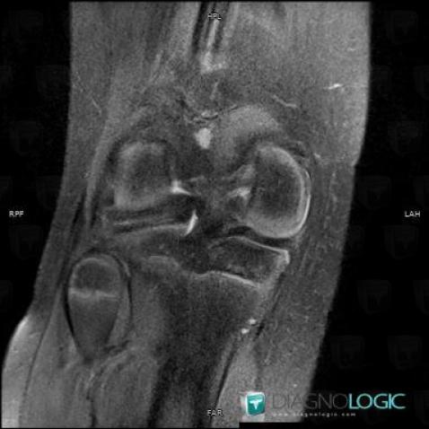 Discoid meniscus , Meniscus, MRI