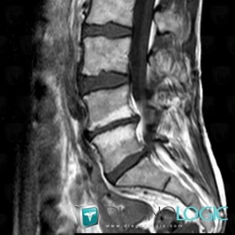 Discopathie dégénérative, Corps vertébral / Disque, IRM