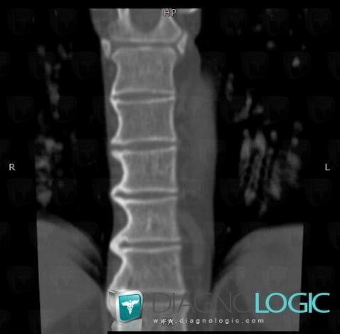 DISH, Vertebral body / Disk, CT