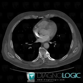 DISH, Vertebral body / Disk, CT