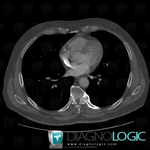 DISH, Vertebral body / Disk, CT