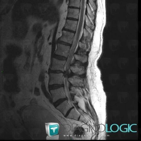 Disk sequestration, Vertebral body / Disk, Spinal canal / Cord, MRI