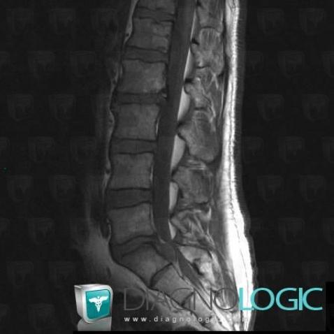 Disk sequestration, Vertebral body / Disk, Spinal canal / Cord, MRI