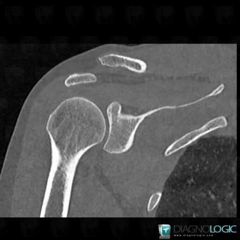 Dislocation, Acromioclavicular joint, CT