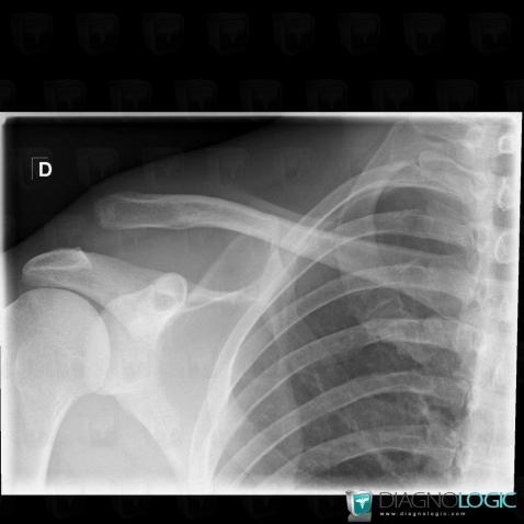 Radiology case : Dislocation (X rays) - Diagnologic