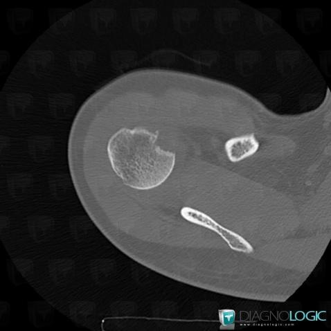 Dislocation, Gleno humeral joint, CT