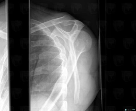 Dislocation, Gleno humeral joint, X rays