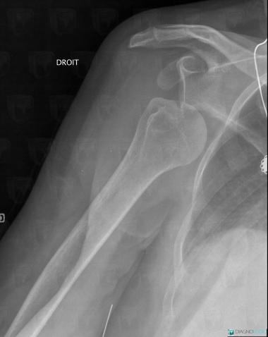 Radiology case : Dislocation (X rays) - Diagnologic