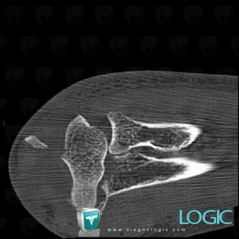 Dislocation, Joints - Elbow, CT