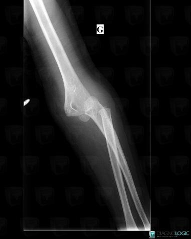 Dislocation, Joints - Elbow, X rays