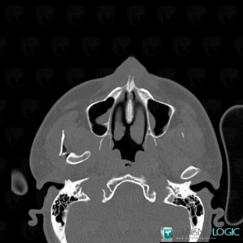 Dislocation, Mandible, CT