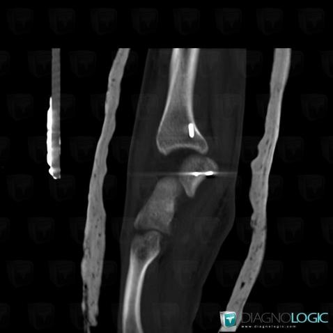 Dislocation, Mediocarpal joint, CT