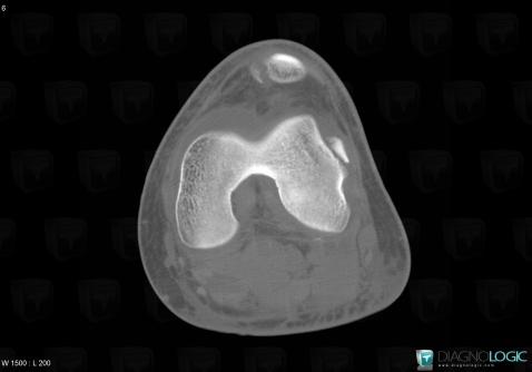 Dislocation, Patellofemoral joint, CT