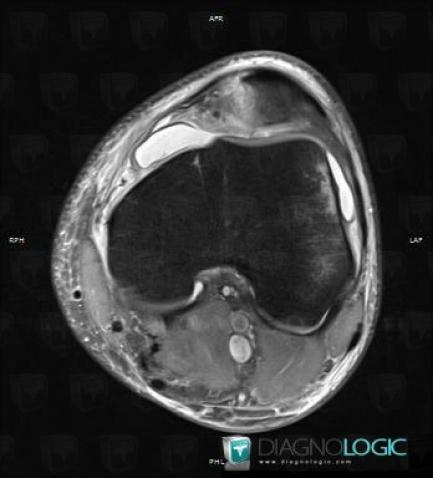 Dislocation, Patellofemoral joint, MRI