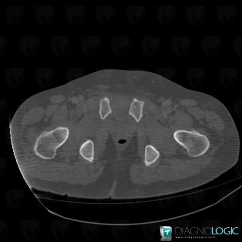 Dislocation, Pubic symphysis, CT