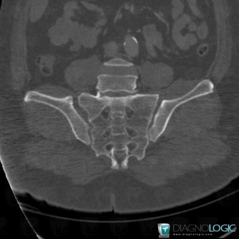 Dislocation, Sacro iliac joint, CT