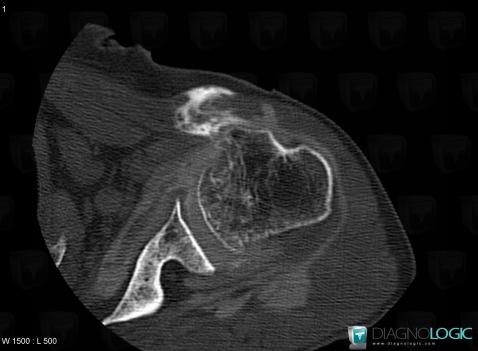 Dislocation-the biceps brachii tendon, Long head-biceps tendon, CT