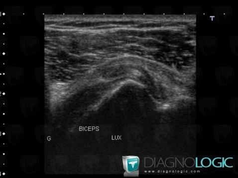 Dislocation-the biceps brachii tendon, Long head-biceps tendon, US