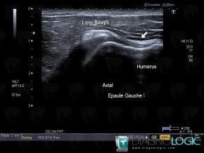 Dislocation-the biceps brachii tendon, Long head-biceps tendon, US
