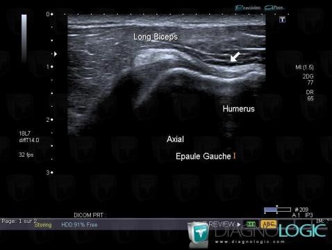Dislocation-the biceps brachii tendon, Long head-biceps tendon, US